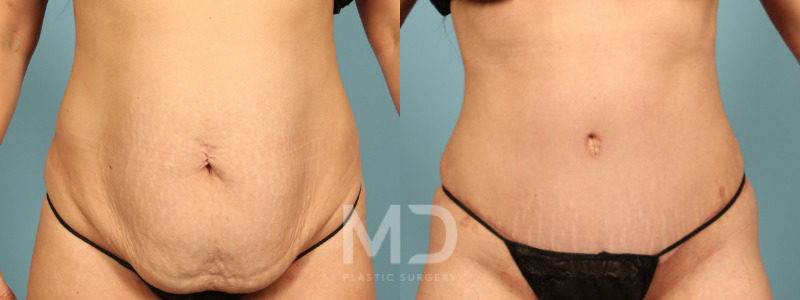 Tummy Tuck 7 Combined Image