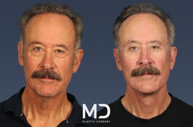 Facelift 6 Combined Image