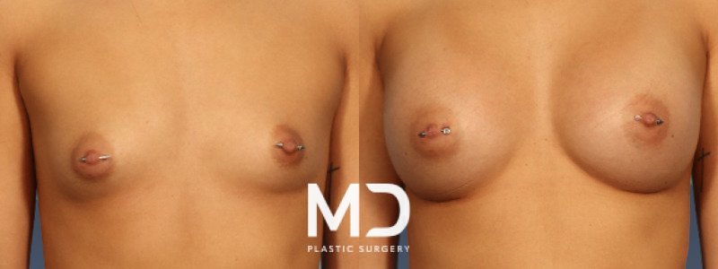Breast Augmentation 1 Combined Image